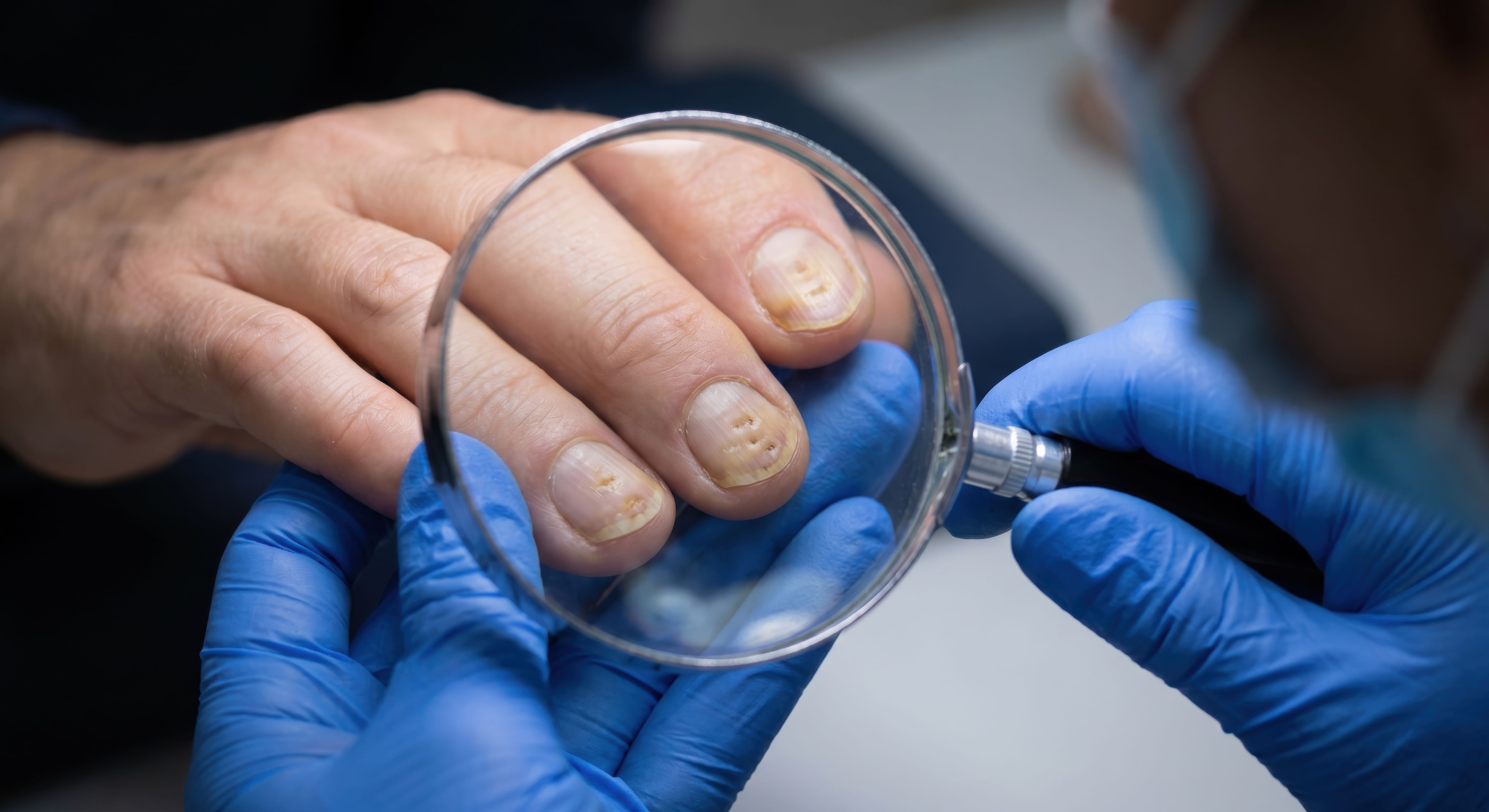 Psoriasis FAQs: What NPs and PAs Should Know