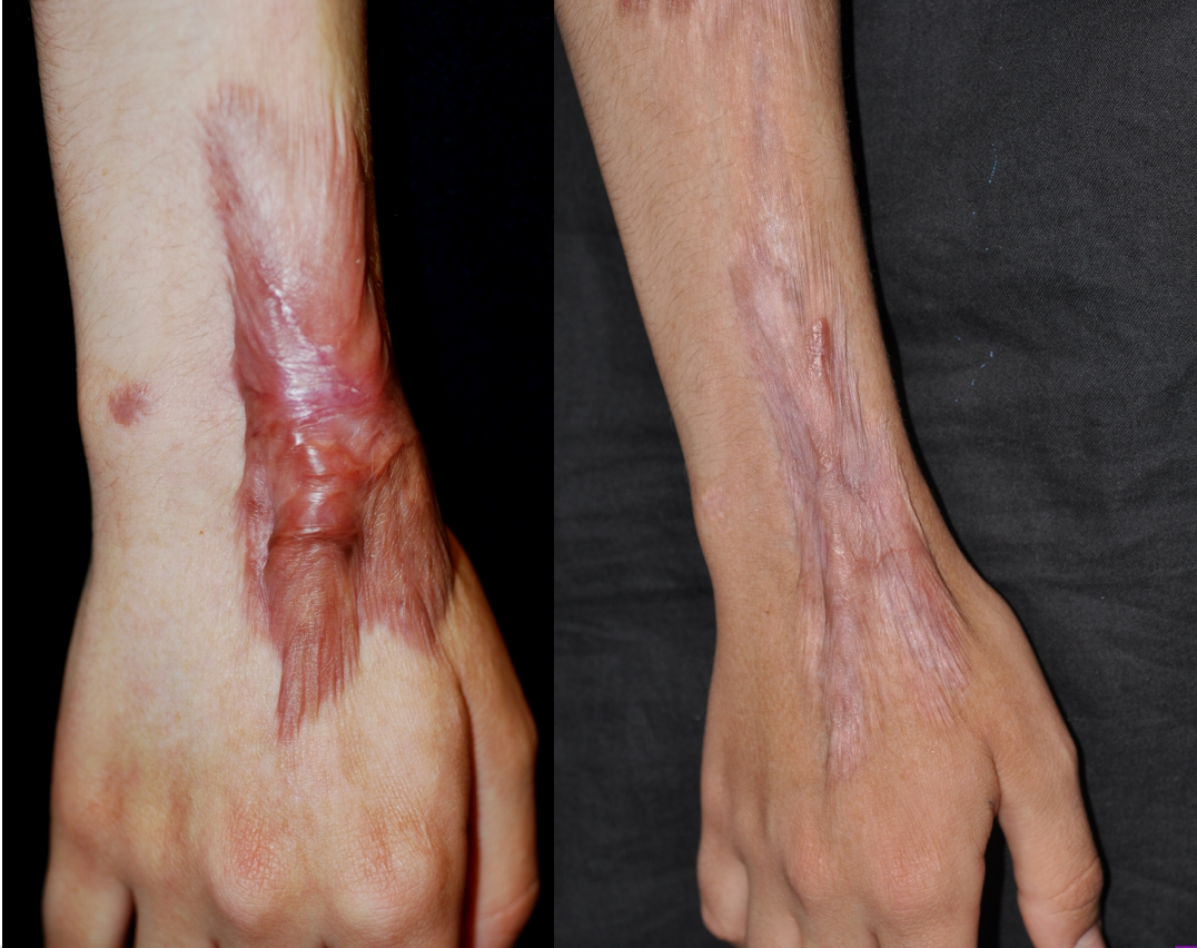 scars on arm