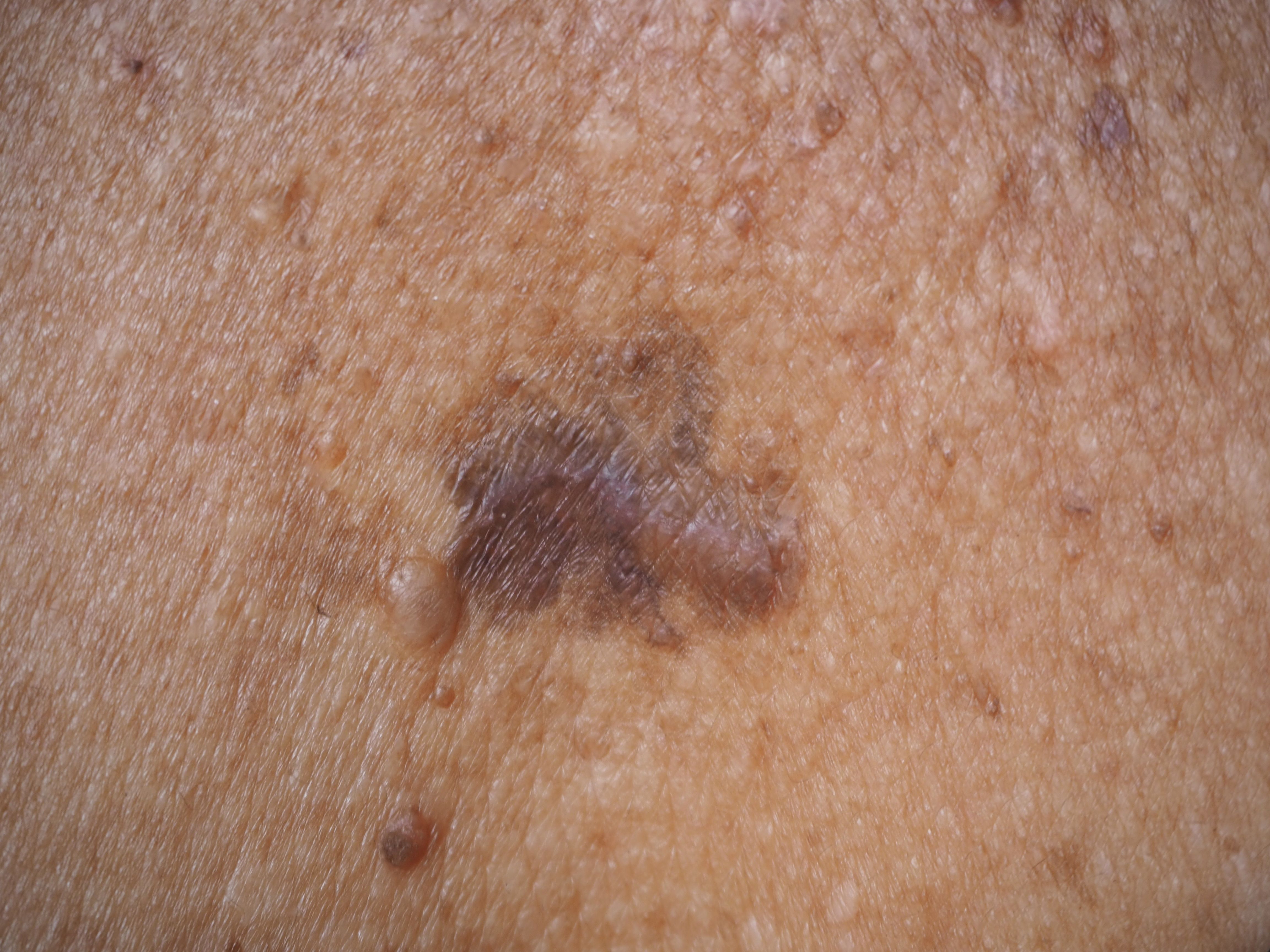 Pediatric Melanoma in Review: Providing Considerations for Dermatologists