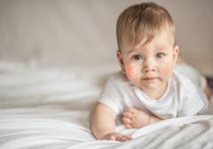 EP. 1 Environmental Factors that Effect Eczema