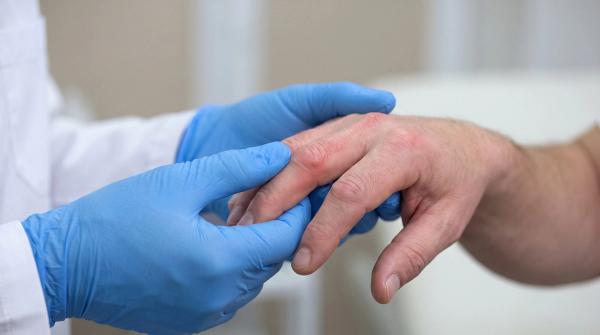 FDA Approves Tildrakizumab for Active Psoriatic Arthritis