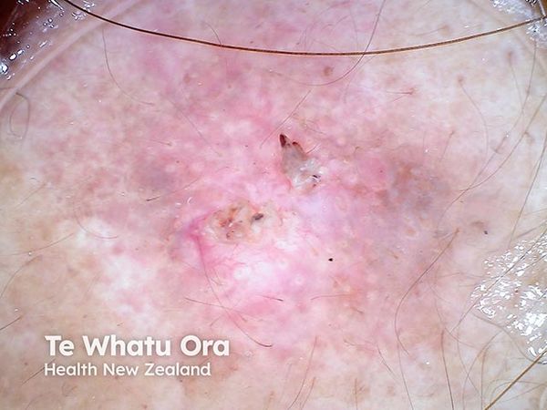 Alpha Tau Submits First PMA Module to FDA for Novel cSCC Treatment, Alpha DaRT