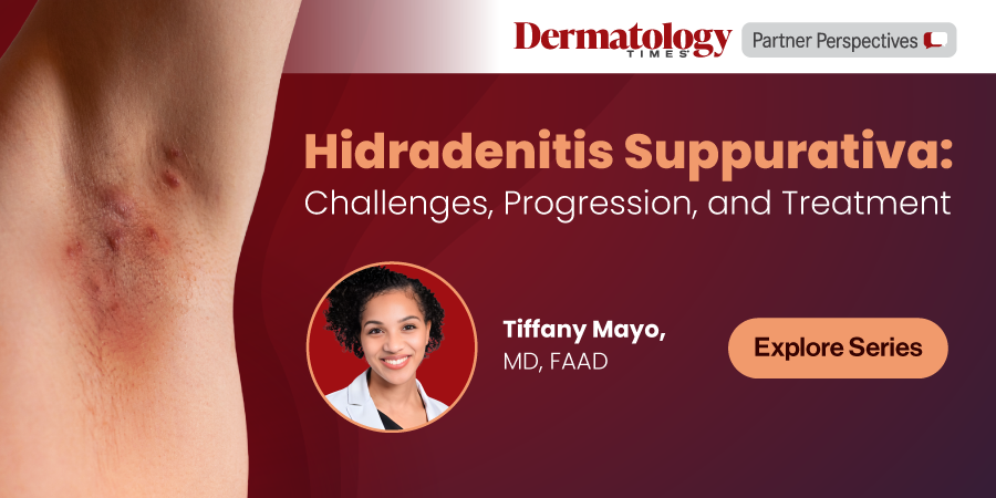 Hidradenitis Suppurativa: Challenges, Progression, and Treatment