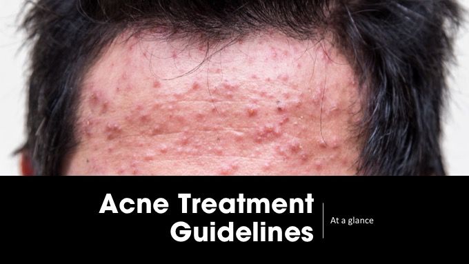Acne treatment guidelines
