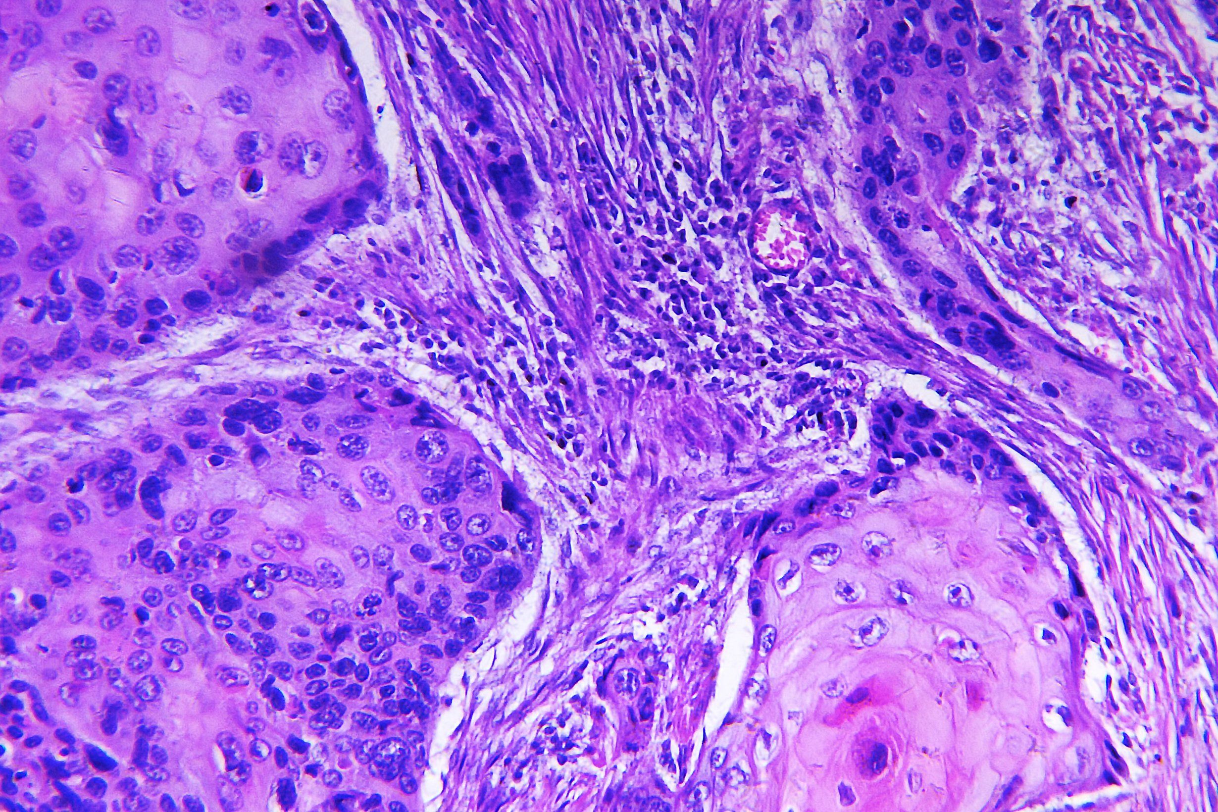 a-paradigm-shift-in-squamous-cell-carcinoma-treatment