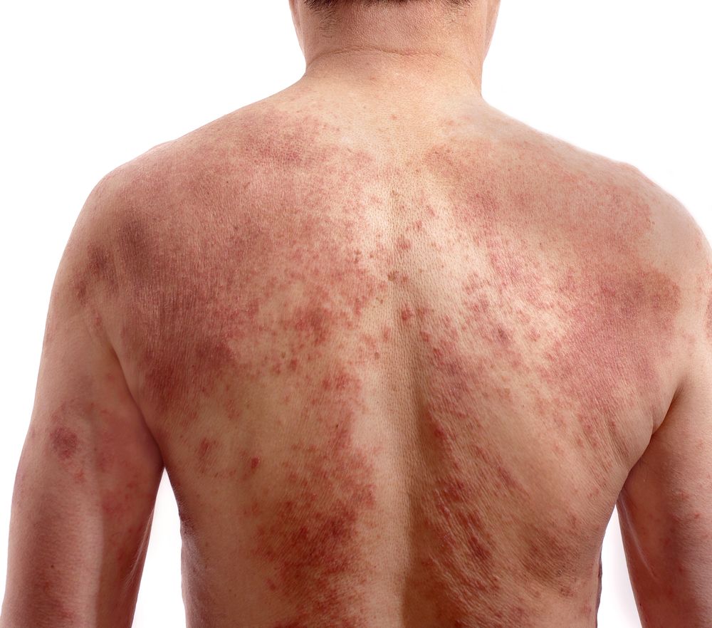 pustular psoriasis