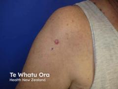 Skin Cancer by the Numbers: A Closer Look at the Latest Data