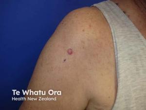 Skin Cancer by the Numbers: A Closer Look at the Latest Data