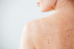 Dermatologists’ Role in Breast Cancer Awareness and Survivorship