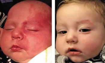 Infant with port-wine stain