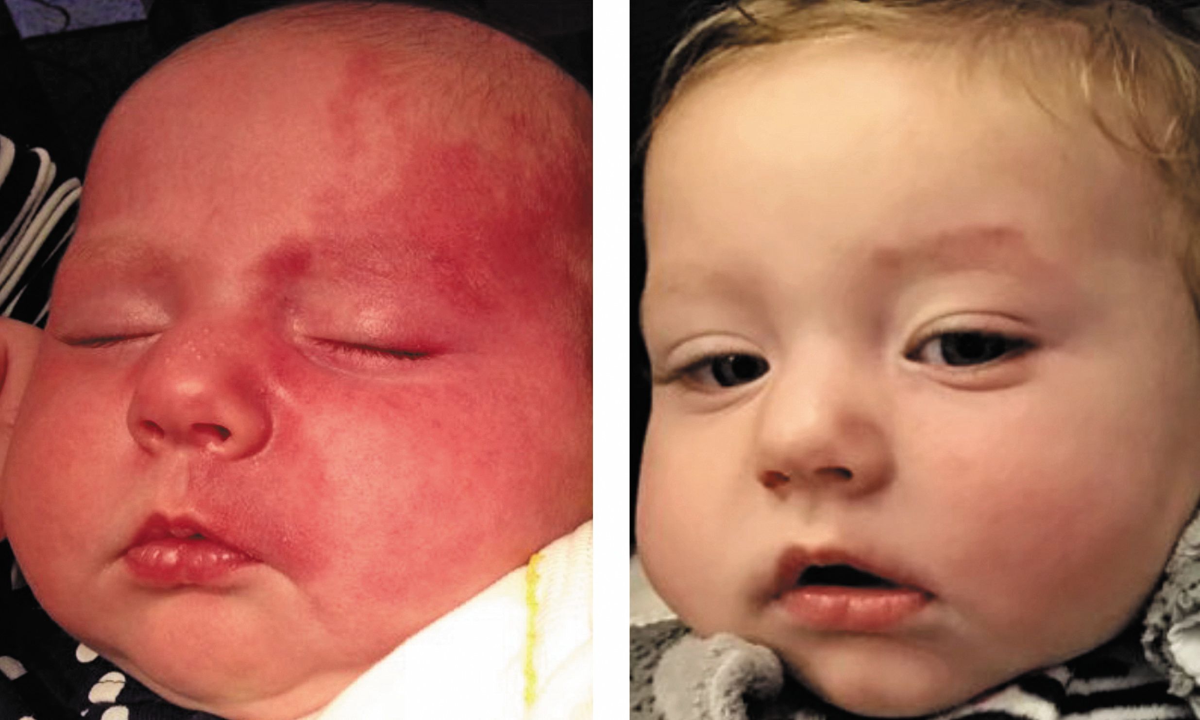 Study examines portwine stain treatment in infants