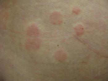 Urticaria