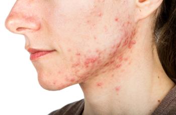 Acne (©OcskayBence/Shutterstock.com)