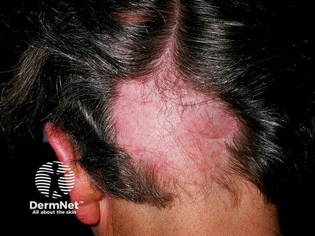 New Phase 3 UP-AA Data Demonstrate Significant Improvement in SALT Score With Upadacitinib in Alopecia