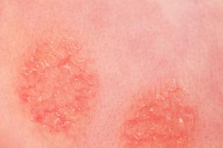A Dermatology Rash Diagnostic for the Allergist