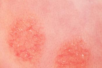 Atopic Dermatitis