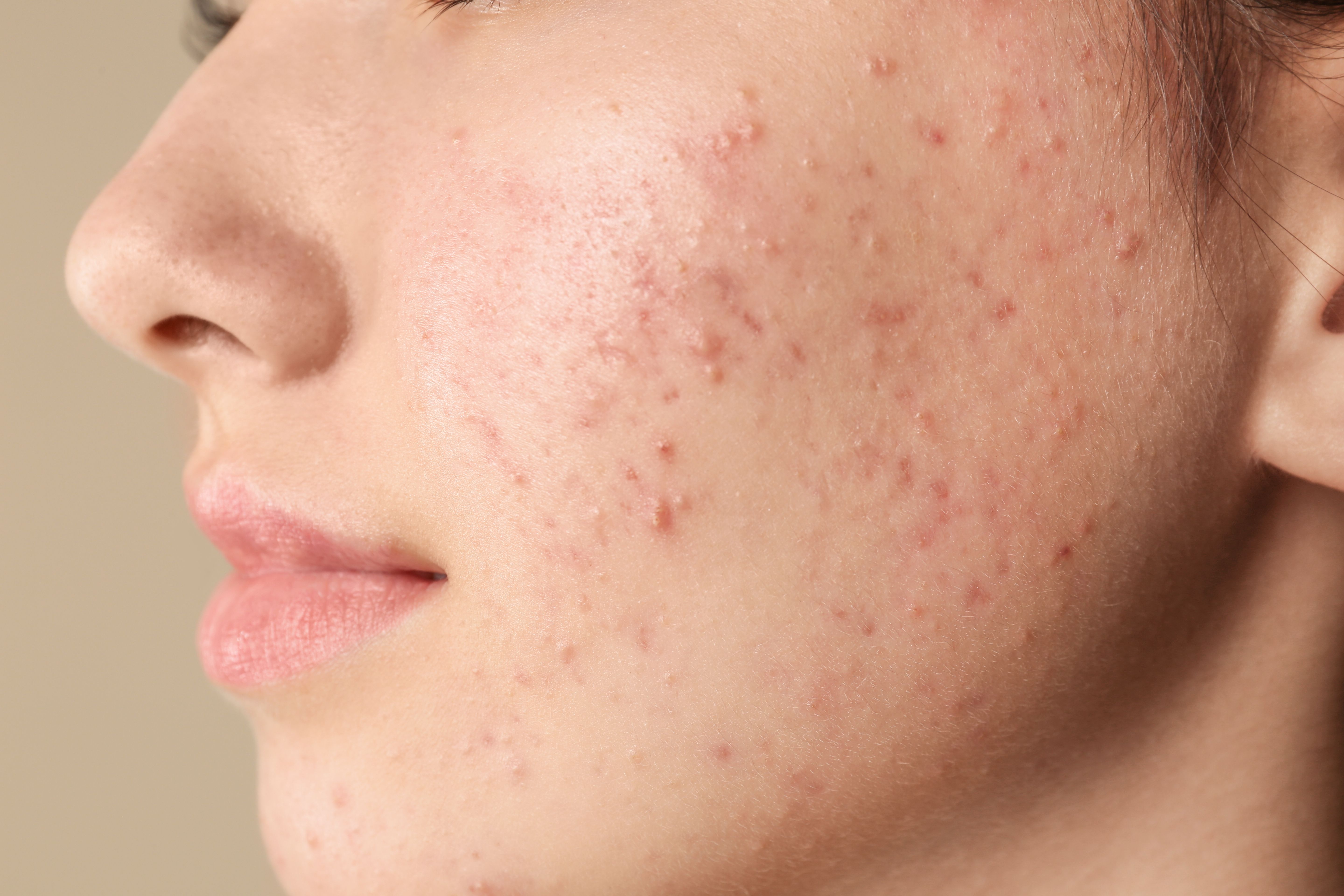 Patients Treated for Acne Exhibit Higher Sebum, Hydration, and TEWL Levels than General Population