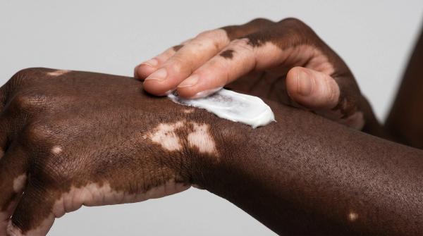 Longer Topical JAK Inhibitor Treatment Linked to Vitiligo Improvement in Real-World Study