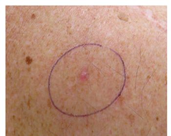 basal cell carcinoma