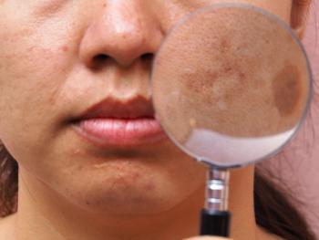 discolored patch of skin on cheek