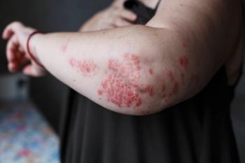 Psoriasis