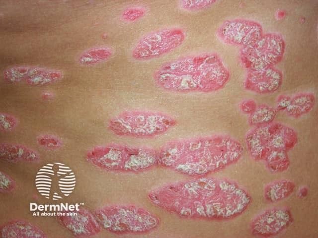 Psoriasis Remicade Rash Comparing Effectiveness of Risankizumab and Deucravacitinib in Plaque ...