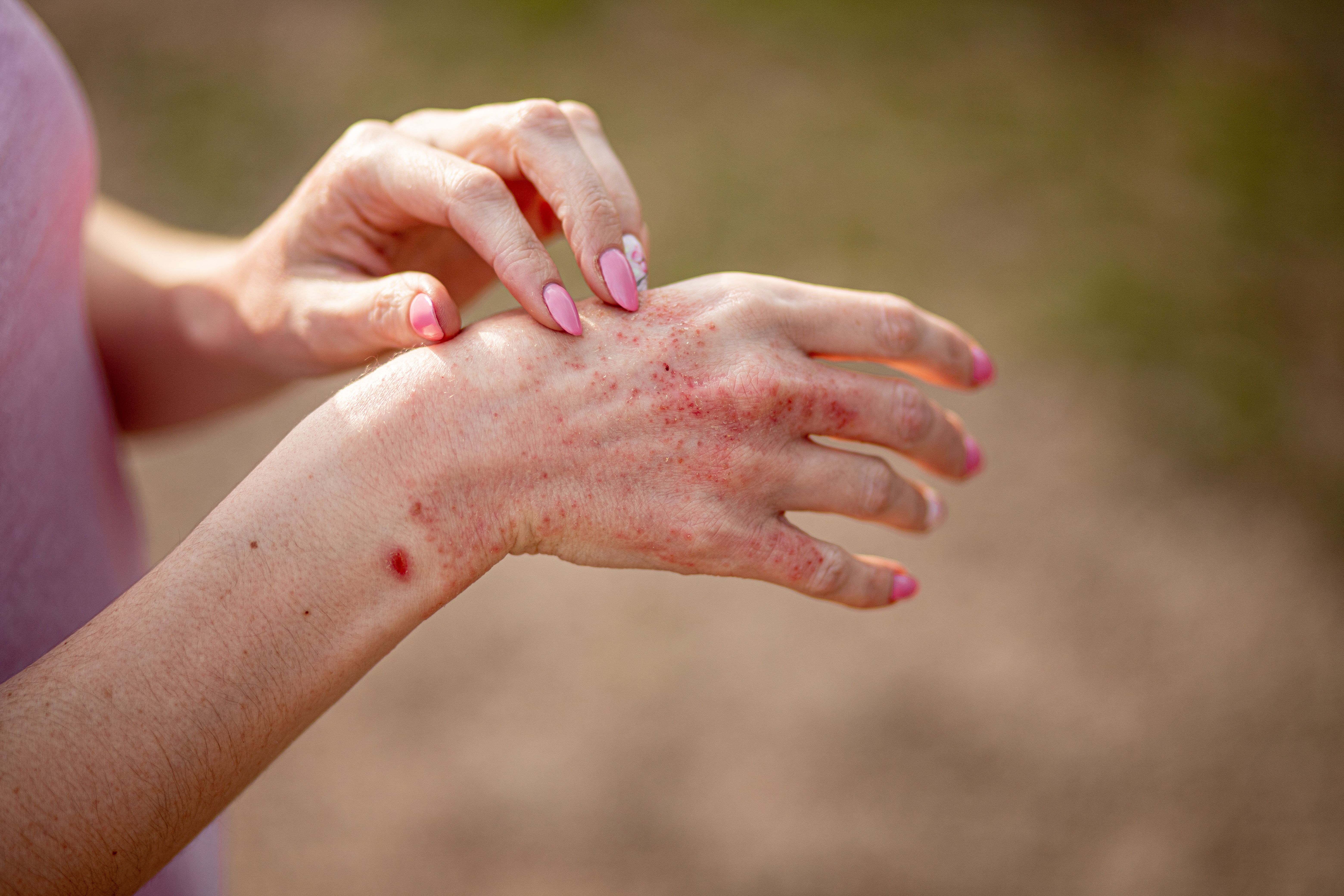 Photosensitive Skin Rash Defining Photosensitivity in Atopic Dermatitis