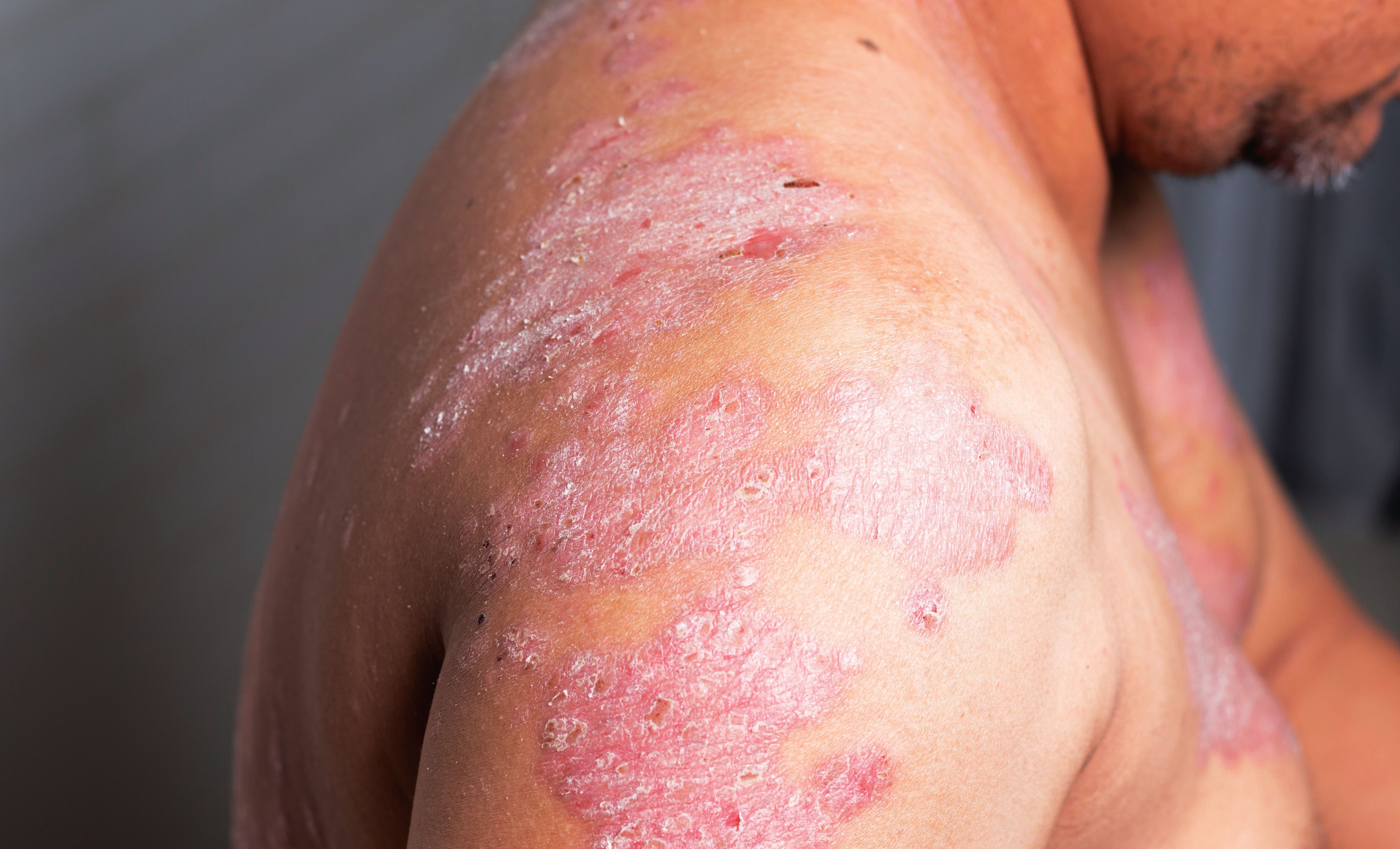 psoriasis