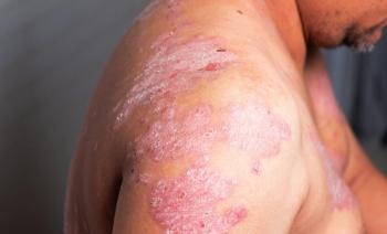psoriasis