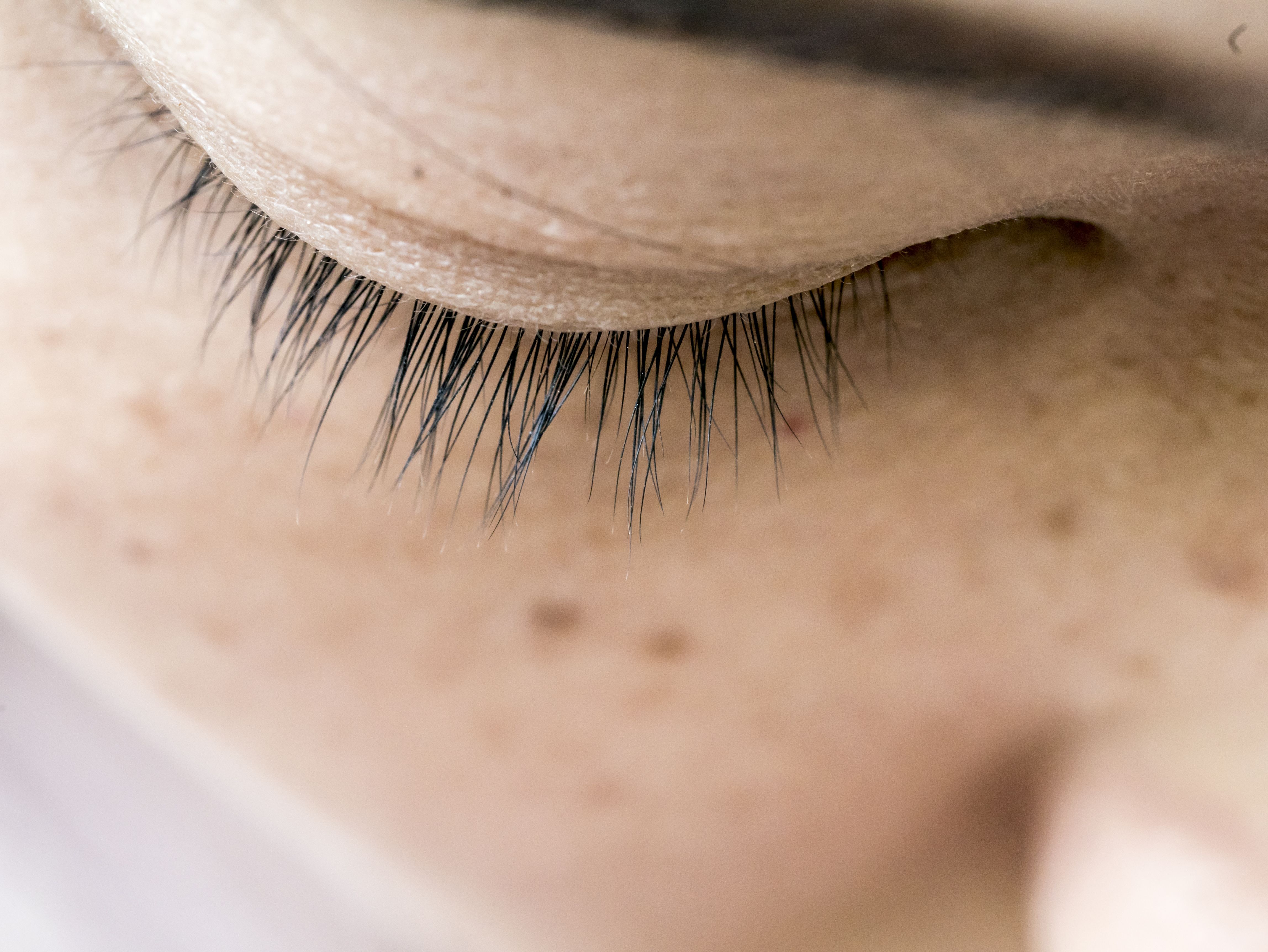 Melasma