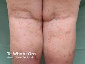 Quality of Life in CSU Shaped by More Than Skin Symptoms