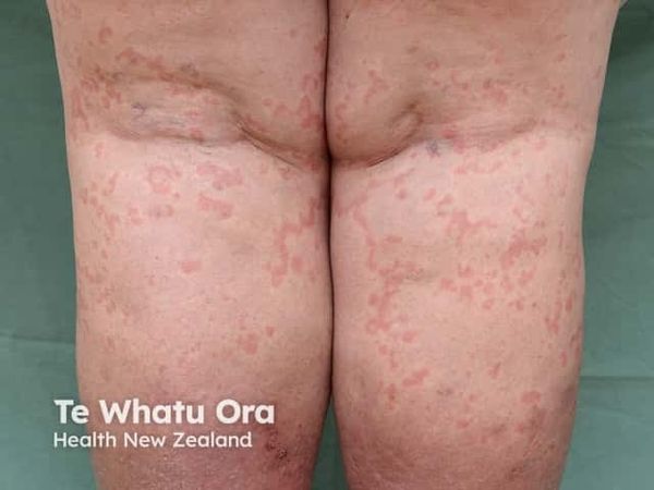 Quality of Life in CSU Shaped by More Than Skin Symptoms