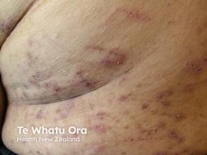 Phase 2 Nemolizumab Trial Opens for CPUO