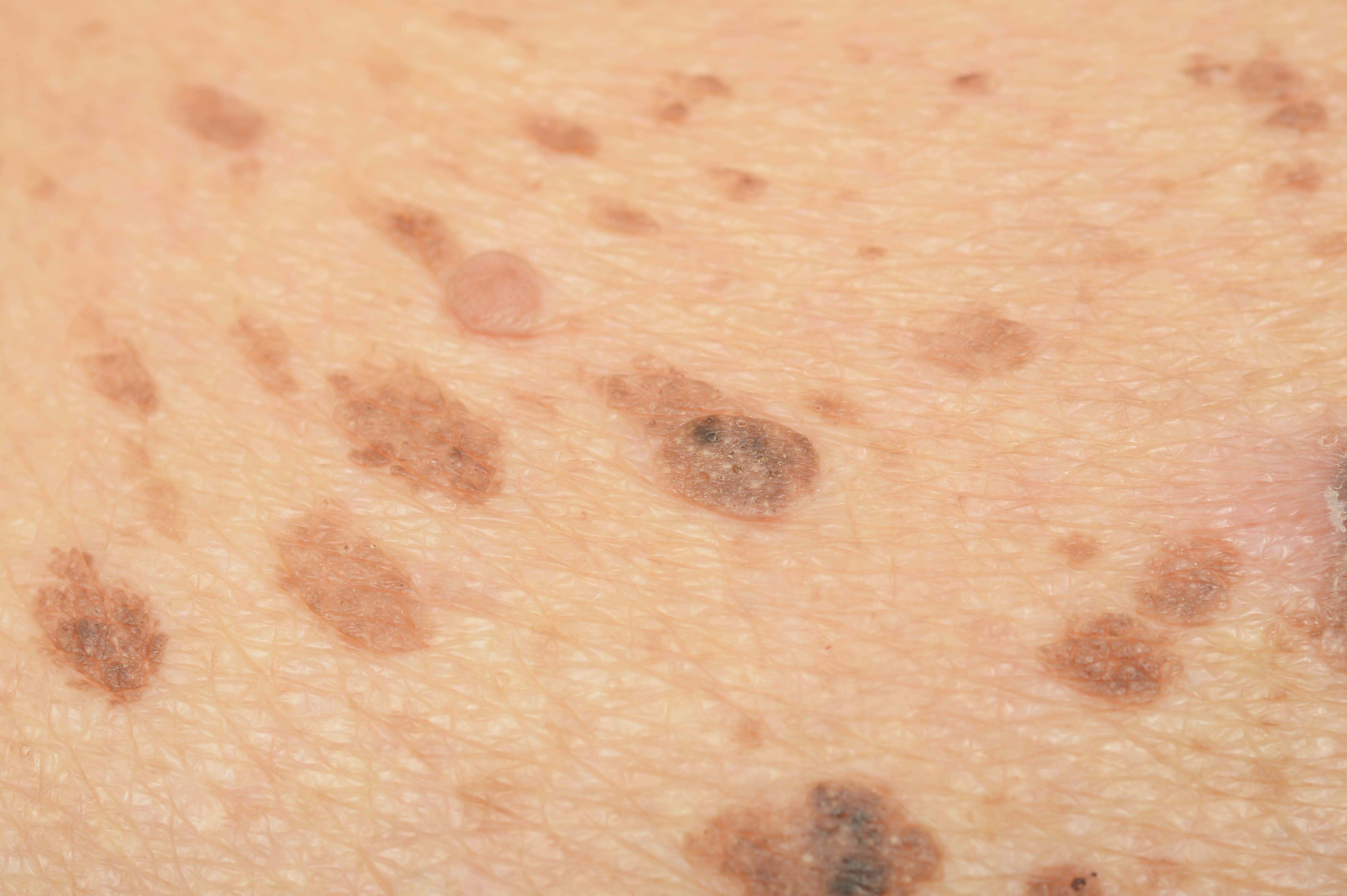 Treatment Options For Benign Lesions Dermatology Times And Multimedia