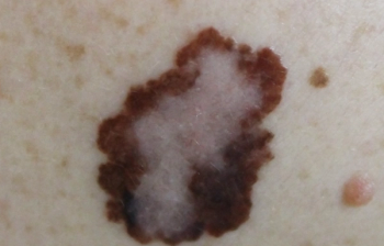 melanoma