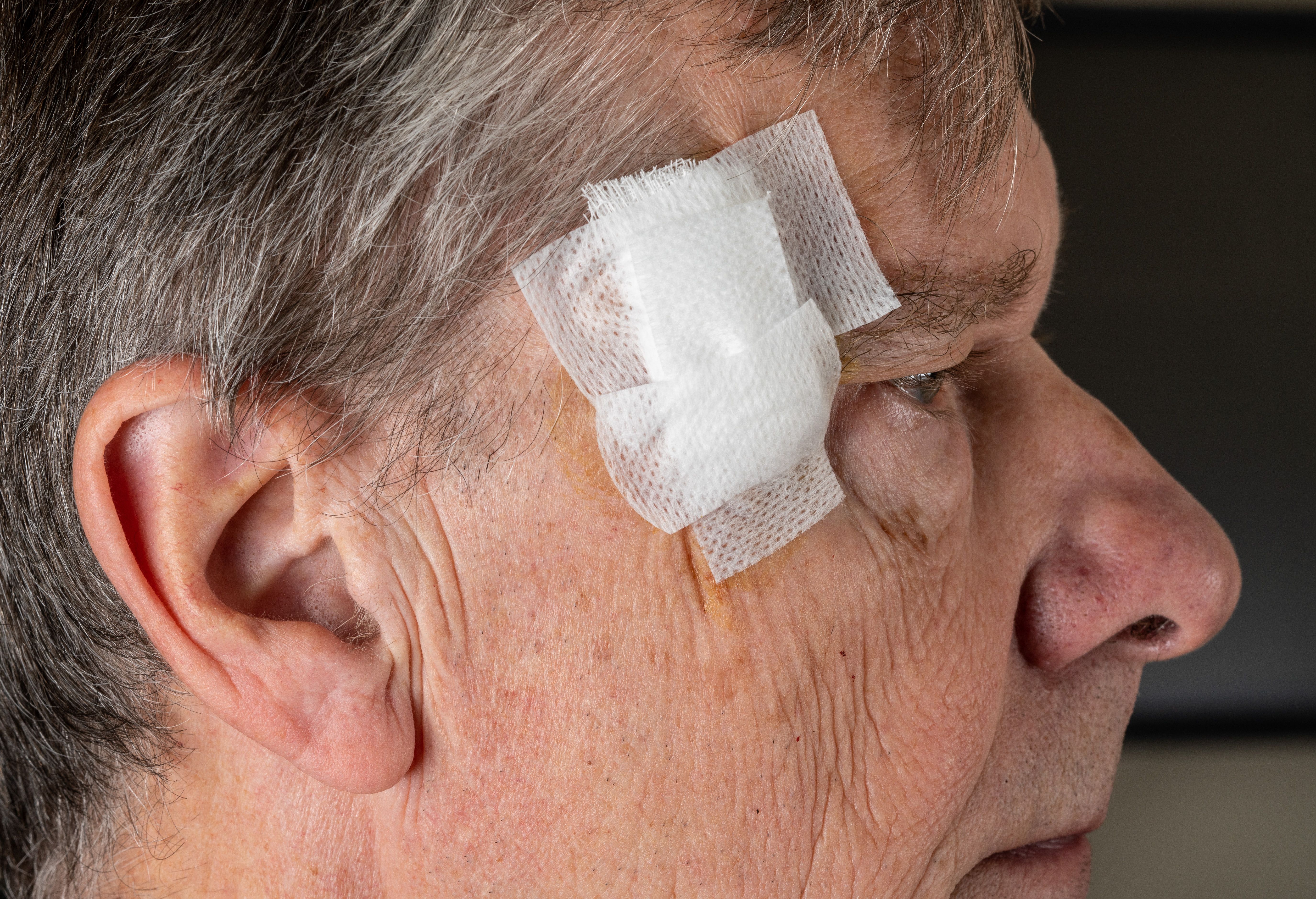 Senior adult male with dressings on Mohs surgery site