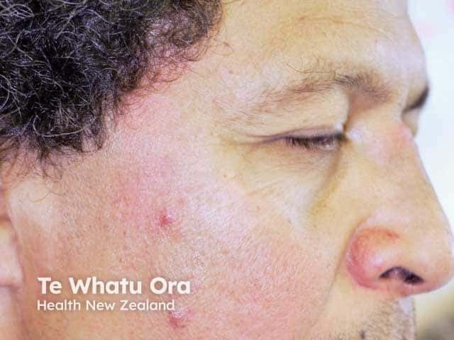 semaglutide and rosacea JAK Inhibition With Upadacitinib and Abrocitinib Shows Potential in Rosacea Treatment