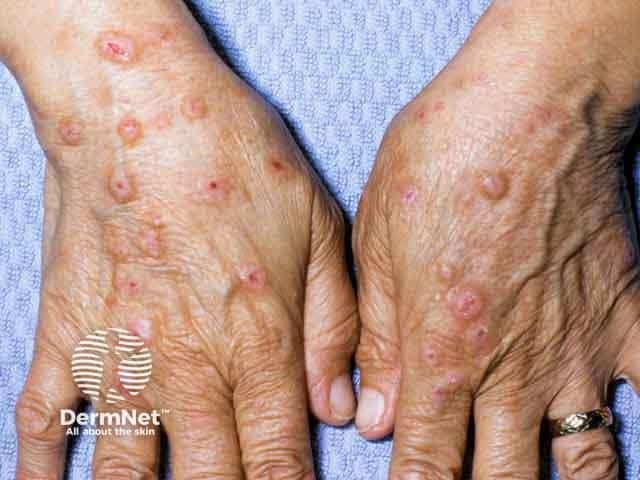<![CDATA[Early Systemic Therapy Crucial for Managing Prurigo Nodularis in Skin of Color]]>