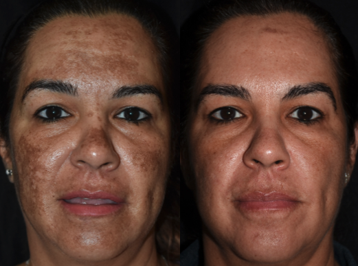 Latino patient with severe melasma before and after 1 treatment with intense pulsed light, 1927-nm laser, and tranexamic acid 650-mg half-tablet twice a day.