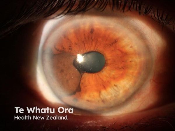 DecisionDx-UM and PRAME Improve Metastatic Risk Prediction in Uveal Melanoma