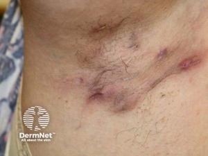 Povorcitinib Shows Sustained Efficacy in HS at 24 Weeks