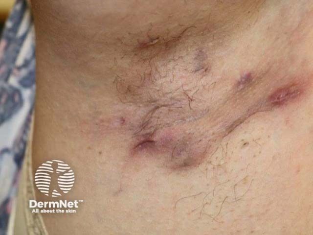 Hs Infection Below the Surface: Dermatologic Procedures for Hidradenitis Suppurativa