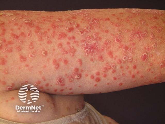 The Psoriasis Pipeline Heats Up: What Clinicians Need to Know