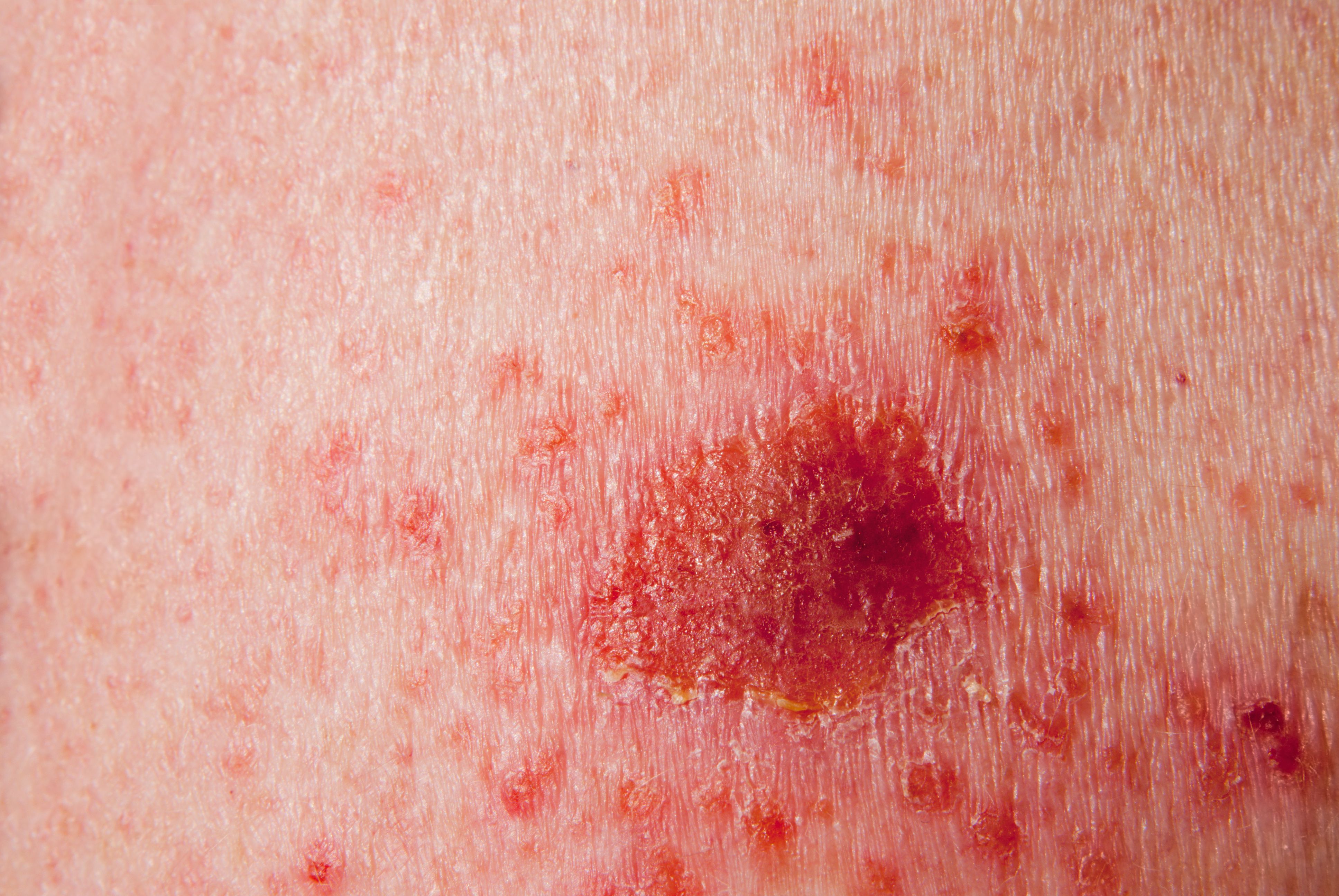 basal cell carcinoma