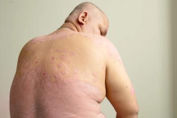 psoriasis patient
