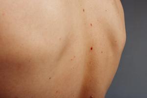 The Expanding Role of Immunotherapies for Non-Melanoma Skin Cancers