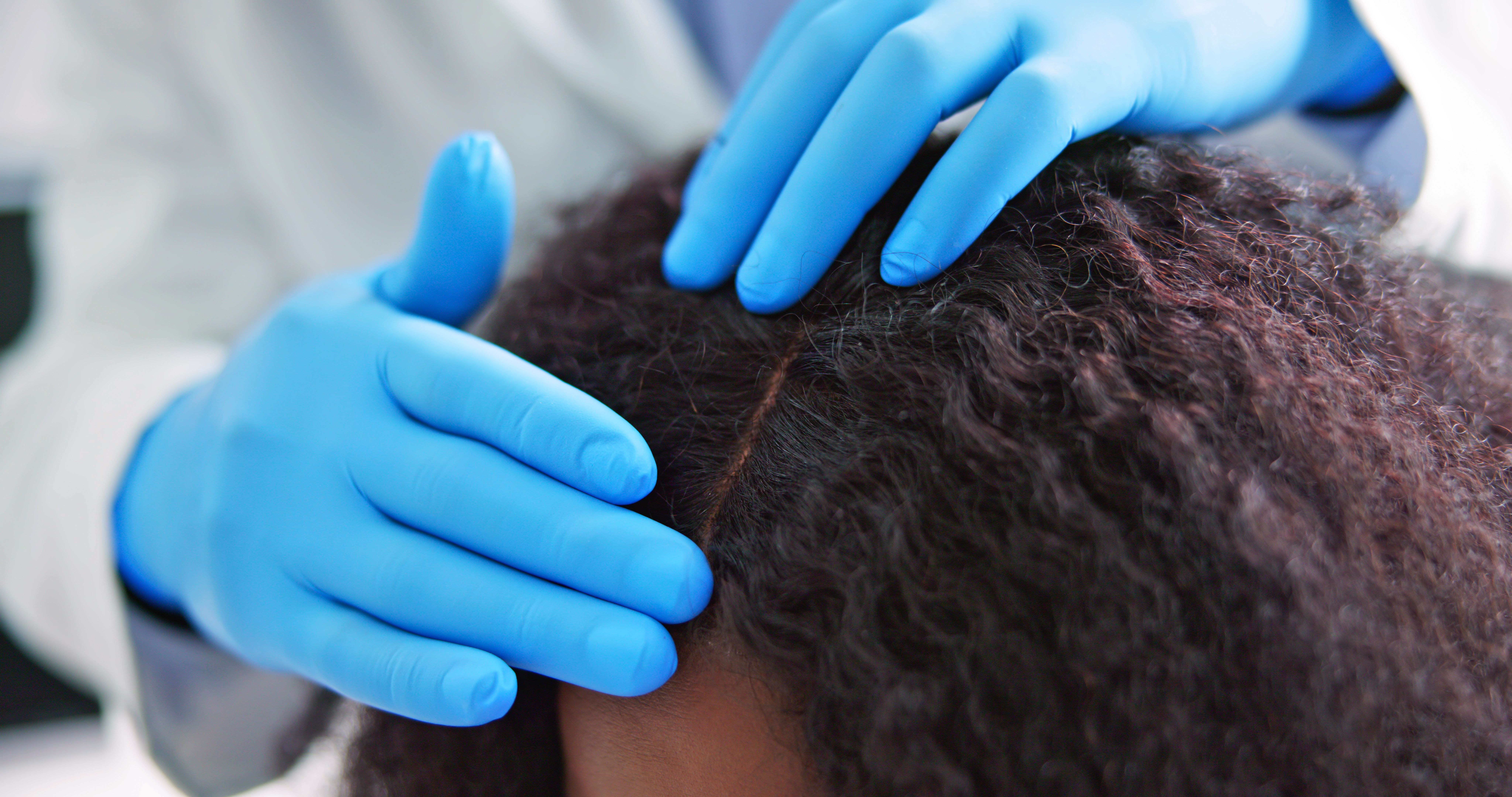Scalp Disorders in SoC: A Diagnostic Blind Spot
