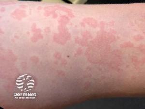 DeepSeek-R1 Outperforms ChatGPT-4o in Urticaria Clinical Queries