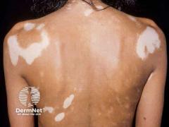 EP. 10 Clinicians Outline Real-World Strategies for Enhancing Vitiligo Outcomes