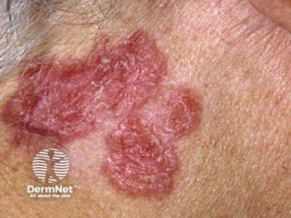 Multidisciplinary Care Anchors Treatment of Advanced cSCC